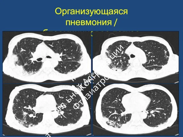 Организующаяся пневмония / «блеомициновое легкое» II Конгресс ьной Ассоциации Фтизиатров Национа л