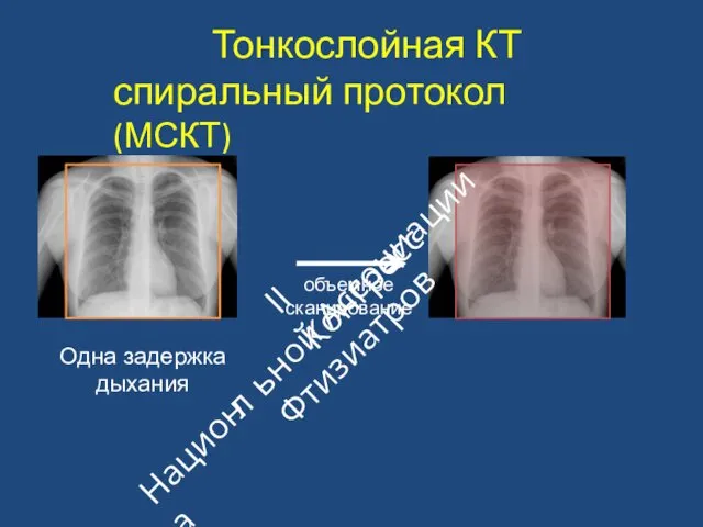 Тонкослойная КТ спиральный протокол (МСКТ) объемное сканирование Одна задержка дыхания II