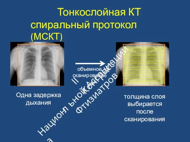 Тонкослойная КТ спиральный протокол (МСКТ) Одна задержка дыхания толщина слоя выбирается