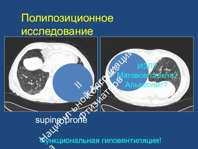 Полипозиционное исследование ИЗЛ? Матовое стекло? Альвеолит? supine prone Функциональная гиповентиляция! II