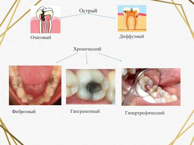 Острый Очаговый Диффузный Хронический Фиброзный Гангренозный Гипертрофический