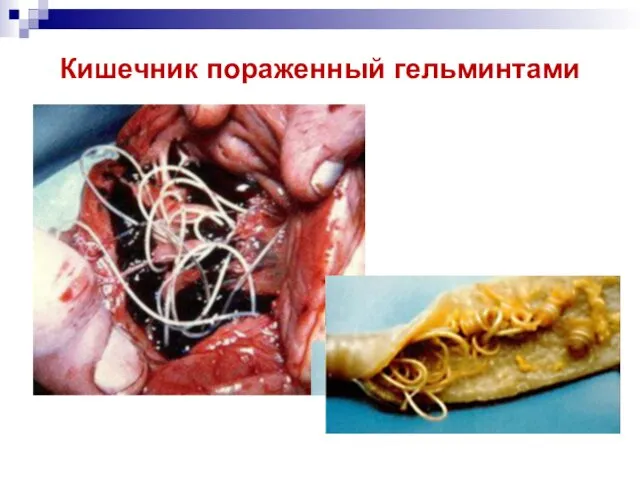 Кишечник пораженный гельминтами