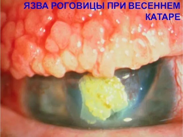 ЯЗВА РОГОВИЦЫ ПРИ ВЕСЕННЕМ КАТАРЕ