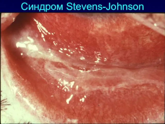 Синдром Stevens-Johnson