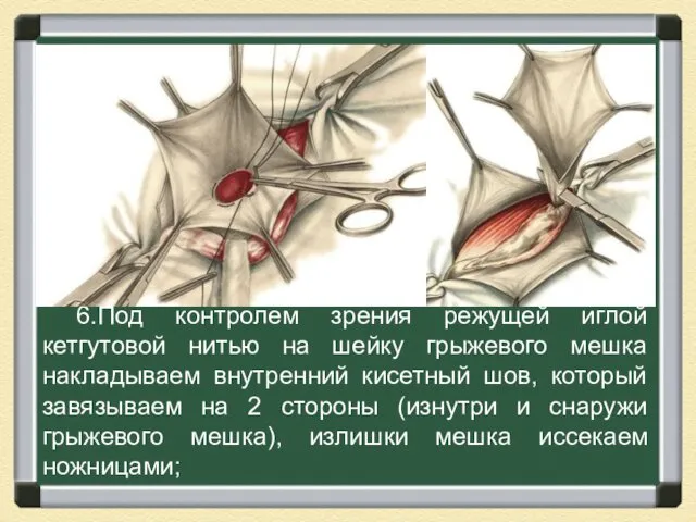 6.Под контролем зрения режущей иглой кетгутовой нитью на шейку грыжевого мешка