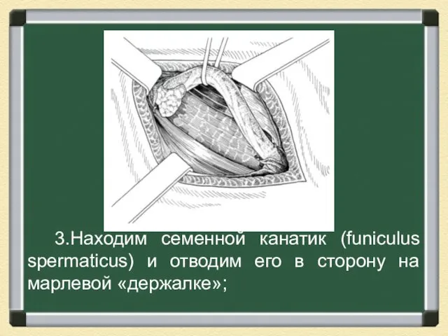 3.Находим семенной канатик (funiculus spermaticus) и отводим его в сторону на марлевой «держалке»;