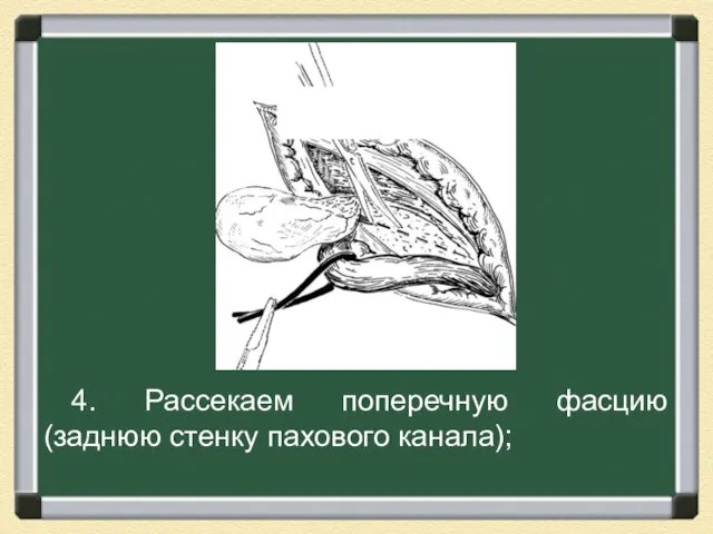 4. Рассекаем поперечную фасцию (заднюю стенку пахового канала);