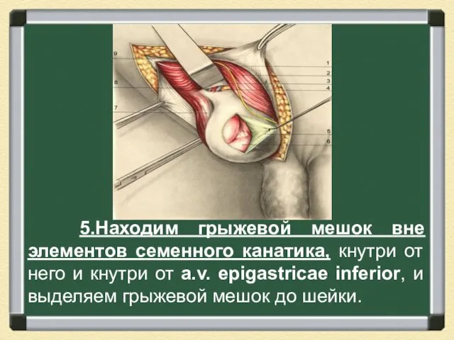 5.Находим грыжевой мешок вне элементов семенного канатика, кнутри от него и