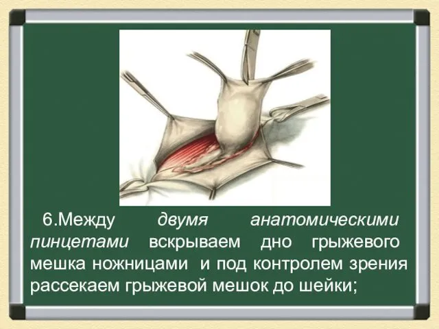 6.Между двумя анатомическими пинцетами вскрываем дно грыжевого мешка ножницами и под