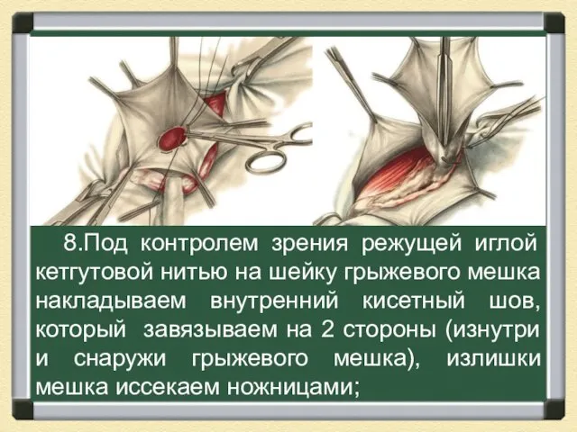 8.Под контролем зрения режущей иглой кетгутовой нитью на шейку грыжевого мешка