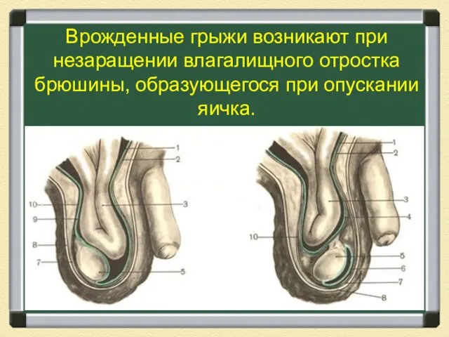 Врожденные грыжи возникают при незаращении влагалищного отростка брюшины, образующегося при опускании яичка.