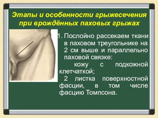 Этапы и особенности грыжесечения при врождённых паховых грыжах Послойно рассекаем ткани