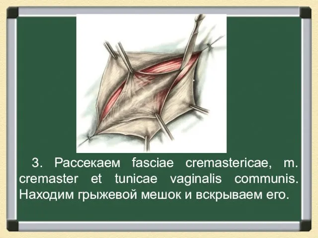 3. Рассекаем fasciae cremastericae, m. cremaster et tunicae vaginalis communis. Находим грыжевой мешок и вскрываем его.