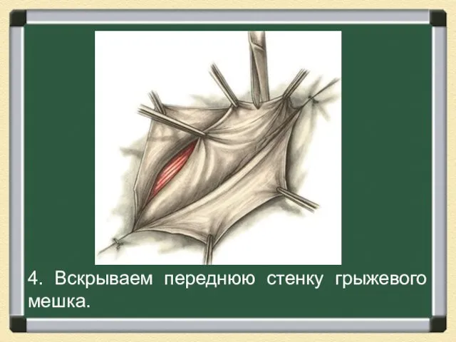 4. Вскрываем переднюю стенку грыжевого мешка.