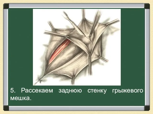 5. Рассекаем заднюю стенку грыжевого мешка.