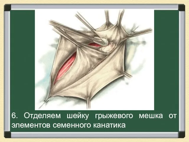 6. Отделяем шейку грыжевого мешка от элементов семенного канатика