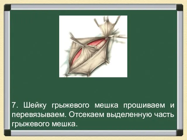 7. Шейку грыжевого мешка прошиваем и перевязываем. Отсекаем выделенную часть грыжевого мешка.