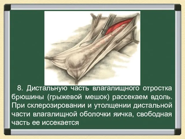 8. Дистальную часть влагалищного отростка брюшины (грыжевой мешок) рассекаем вдоль. При