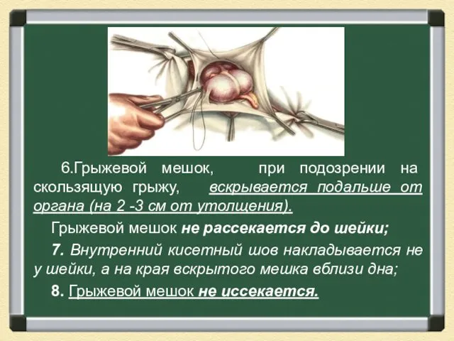 6.Грыжевой мешок, при подозрении на скользящую грыжу, вскрывается подальше от органа