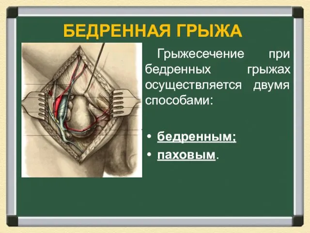 БЕДРЕННАЯ ГРЫЖА Грыжесечение при бедренных грыжах осуществляется двумя способами: бедренным; паховым.