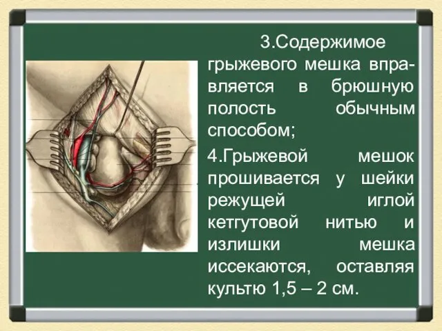 3.Содержимое грыжевого мешка впра-вляется в брюшную полость обычным способом; 4.Грыжевой мешок