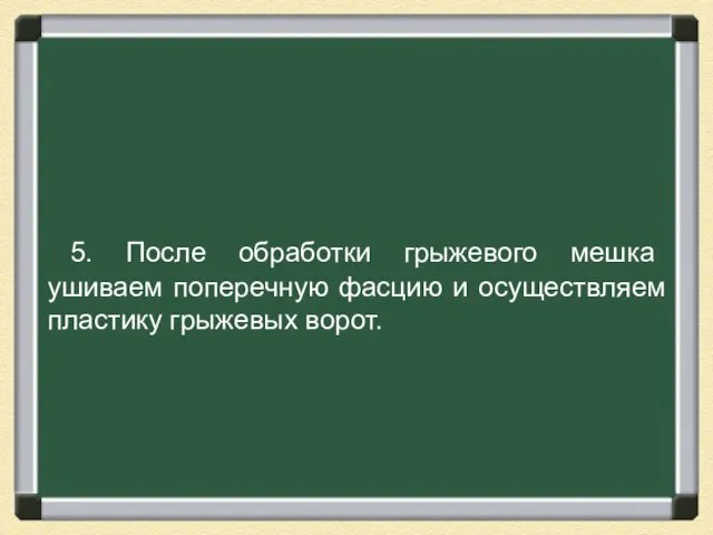 5. После обработки грыжевого мешка ушиваем поперечную фасцию и осуществляем пластику грыжевых ворот.