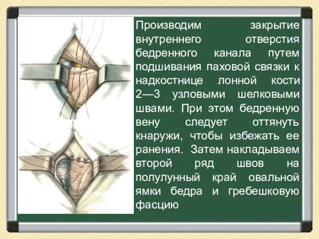 Производим закрытие внутреннего отверстия бедренного канала путем подшивания паховой связки к