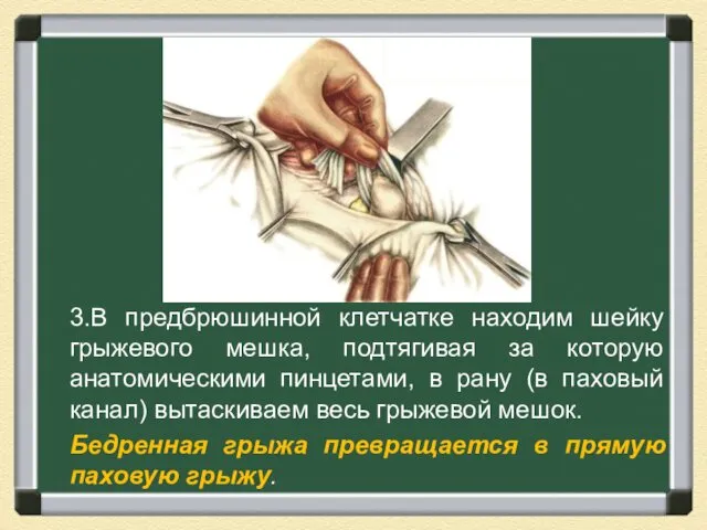 3.В предбрюшинной клетчатке находим шейку грыжевого мешка, подтягивая за которую анатомическими