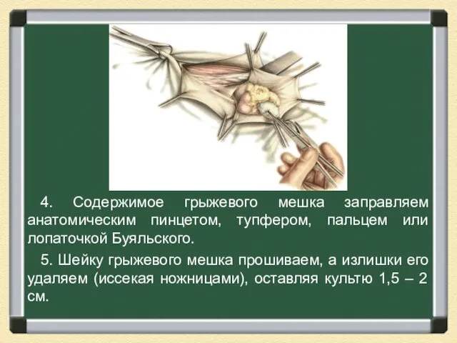 4. Содержимое грыжевого мешка заправляем анатомическим пинцетом, тупфером, пальцем или лопаточкой