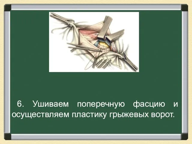 6. Ушиваем поперечную фасцию и осуществляем пластику грыжевых ворот.