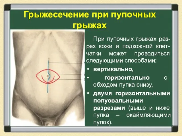 Грыжесечение при пупочных грыжах При пупочных грыжах раз-рез кожи и подкожной