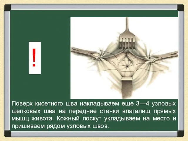 Поверх кисетного шва накладываем еще 3—4 узловых шелковых шва на передние