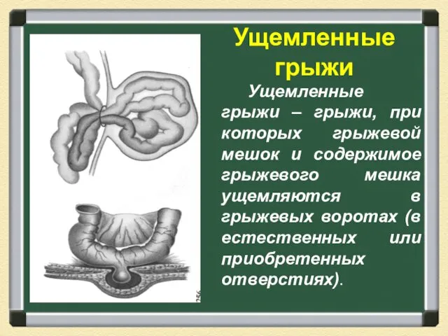 Ущемленные грыжи Ущемленные грыжи – грыжи, при которых грыжевой мешок и