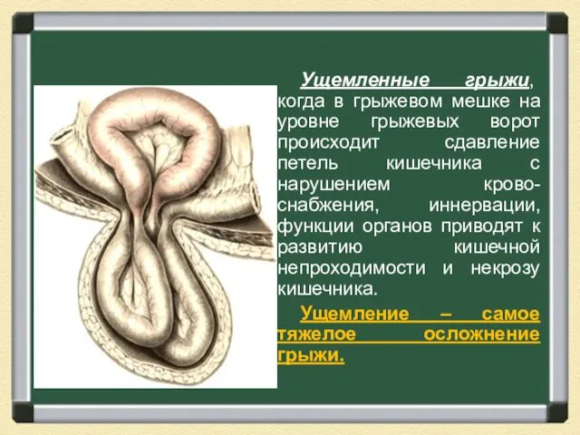 Ущемленные грыжи, когда в грыжевом мешке на уровне грыжевых ворот происходит