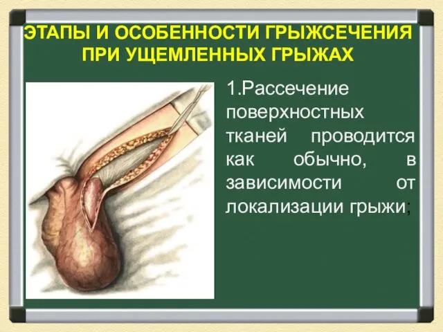 ЭТАПЫ И ОСОБЕННОСТИ ГРЫЖСЕЧЕНИЯ ПРИ УЩЕМЛЕННЫХ ГРЫЖАХ 1.Рассечение поверхностных тканей проводится