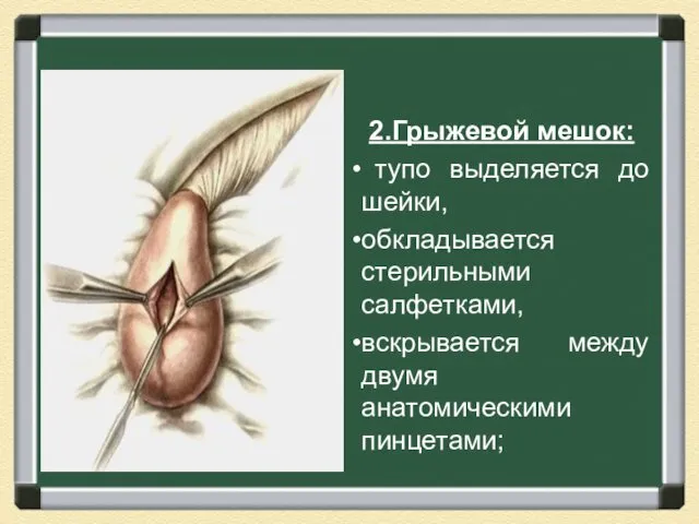 2.Грыжевой мешок: тупо выделяется до шейки, обкладывается стерильными cалфетками, вскрывается между двумя анатомическими пинцетами;