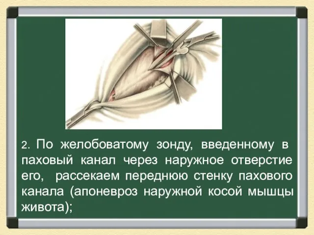 2. По желобоватому зонду, введенному в паховый канал через наружное отверстие