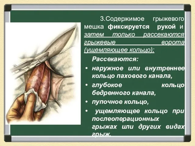 3.Содержимое грыжевого мешка фиксируется рукой и затем только рассекаются грыжевые ворота