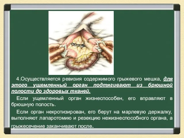 4.Осуществляется ревизия содержимого грыжевого мешка, для этого ущемленный орган подтягивают из