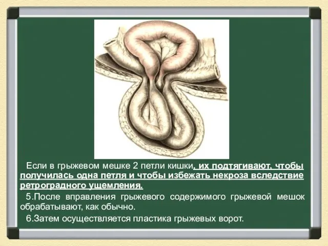 Если в грыжевом мешке 2 петли кишки, их подтягивают, чтобы получилась