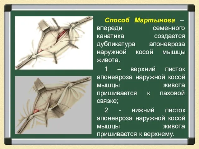 Способ Мартынова – впереди семенного канатика создается дубликатура апоневроза наружной косой