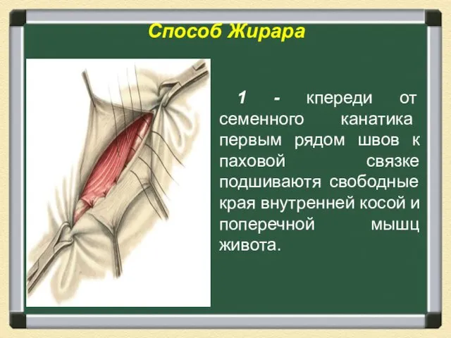 Способ Жирара 1 - кпереди от семенного канатика первым рядом швов