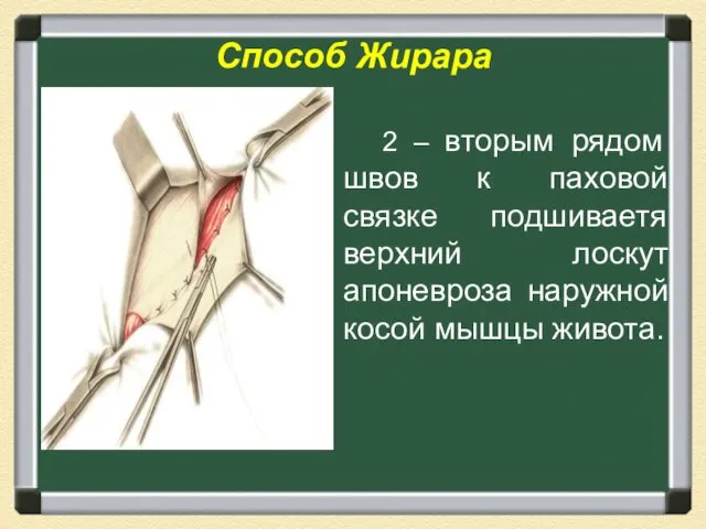 Способ Жирара 2 – вторым рядом швов к паховой связке подшиваетя