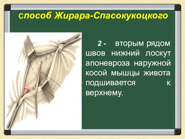 Способ Жирара-Спасокукоцкого 2 - вторым рядом швов нижний лоскут апоневроза наружной