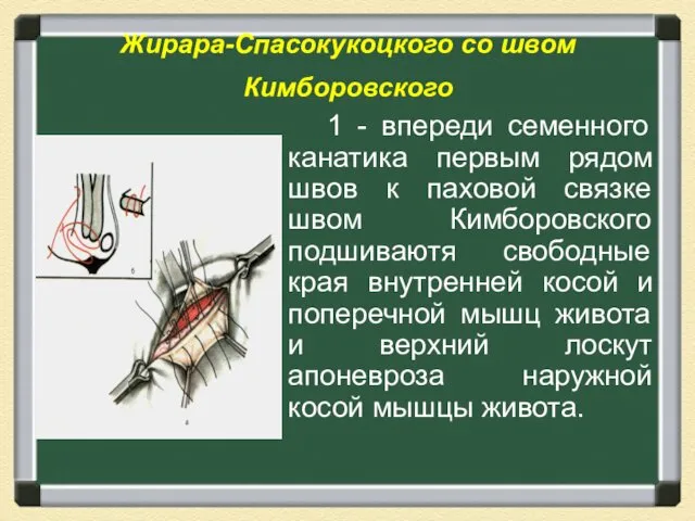 Жирара-Спасокукоцкого со швом Кимборовского 1 - впереди семенного канатика первым рядом