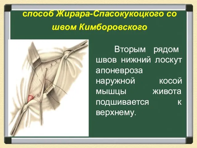 способ Жирара-Спасокукоцкого со швом Кимборовского Вторым рядом швов нижний лоскут апоневроза