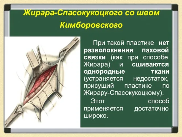 Жирара-Спасокукоцкого со швом Кимборовского При такой пластике нет разволокнения паховой связки