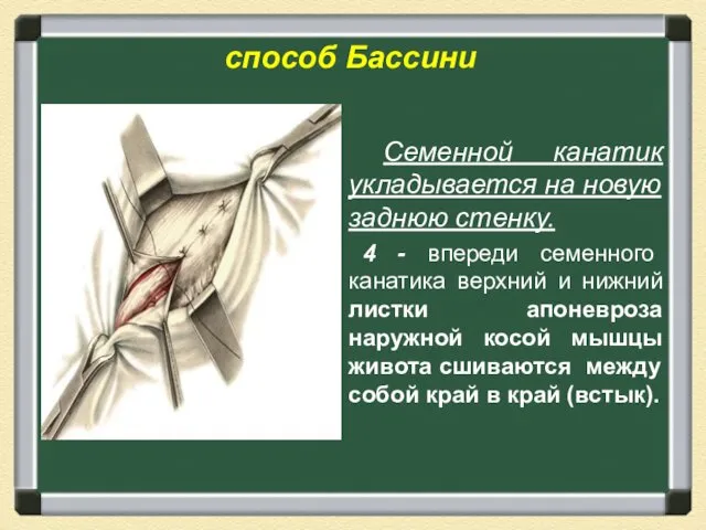 способ Бассини Семенной канатик укладывается на новую заднюю стенку. 4 -