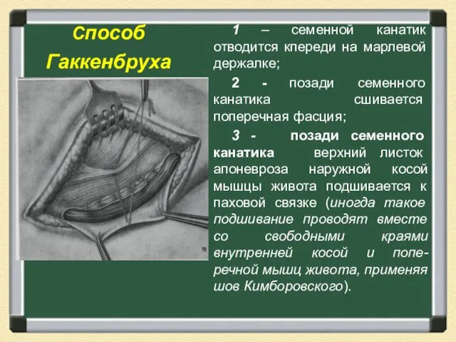 Способ Гаккенбруха 1 – семенной канатик отводится кпереди на марлевой держалке;