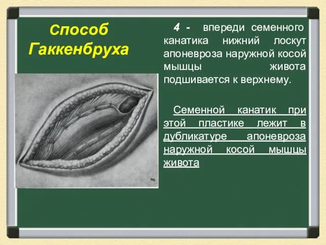 Способ Гаккенбруха 4 - впереди семенного канатика нижний лоскут апоневроза наружной